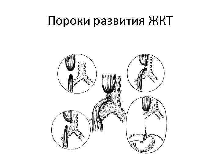 Пороки развития ЖКТ 