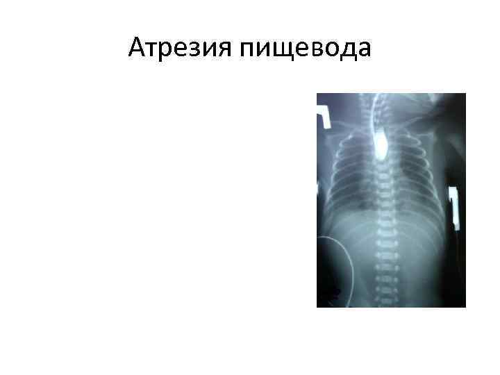 Атрезия пищевода 