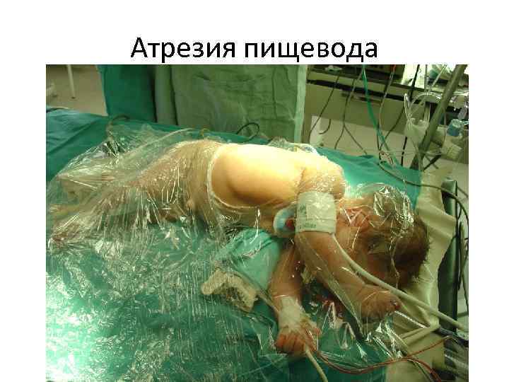 Атрезия пищевода 