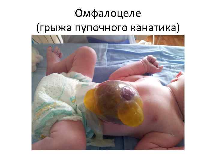 Омфалоцеле (грыжа пупочного канатика) 