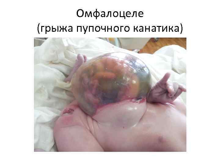Омфалоцеле (грыжа пупочного канатика) 