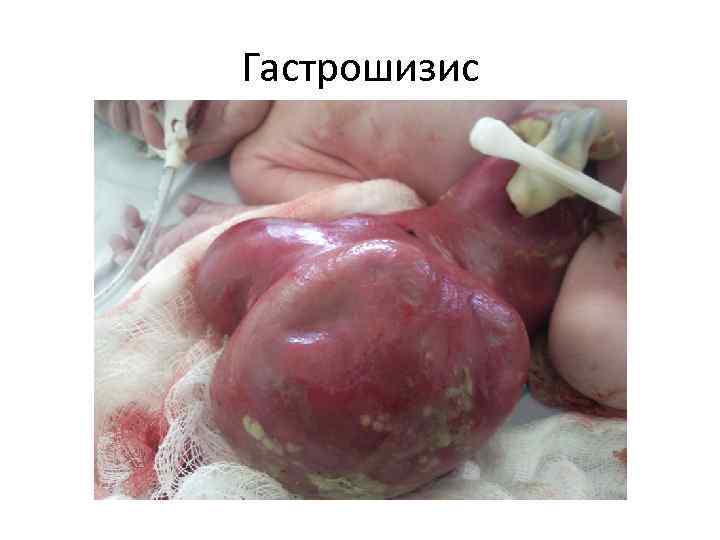 Гастрошизис 