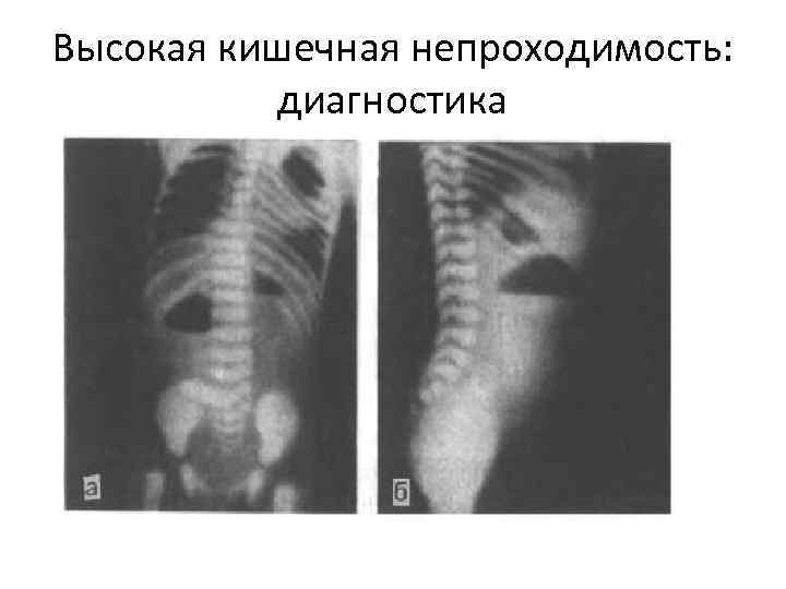 Высокая кишечная непроходимость: диагностика 