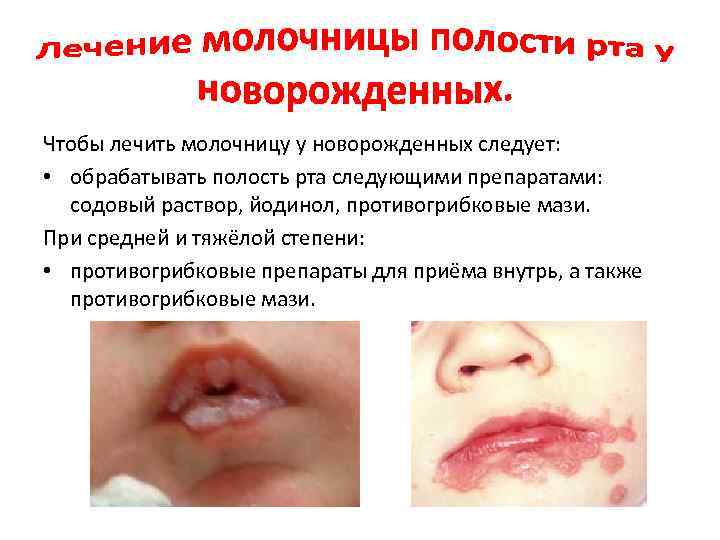 Чтобы лечить молочницу у новорожденных следует: • обрабатывать полость рта следующими препаратами: содовый раствор,