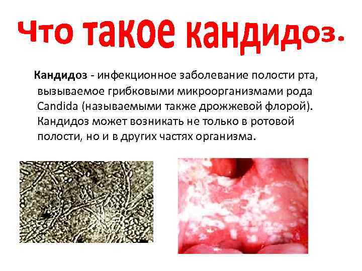  Кандидоз - инфекционное заболевание полости рта, вызываемое грибковыми микроорганизмами рода Candida (называемыми также