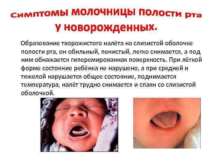 Образование творожистого налёта на слизистой оболочке полости рта, он обильный, пенистый, легко снимается, а