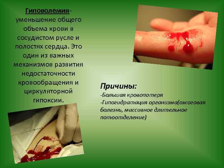 Гиповолемия уменьшение общего объема крови в сосудистом русле и полостях сердца. Это один из