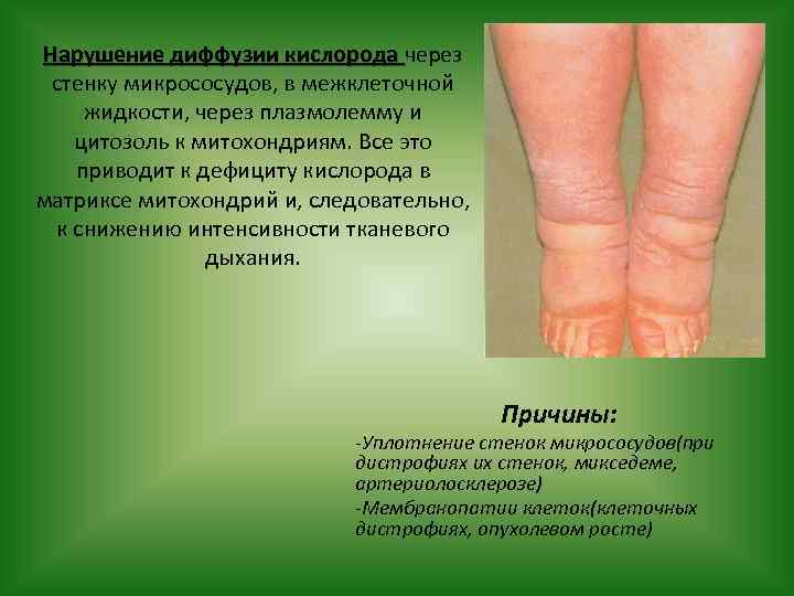 Нарушение диффузии кислорода через стенку микрососудов, в межклеточной жидкости, через плазмолемму и цитозоль к