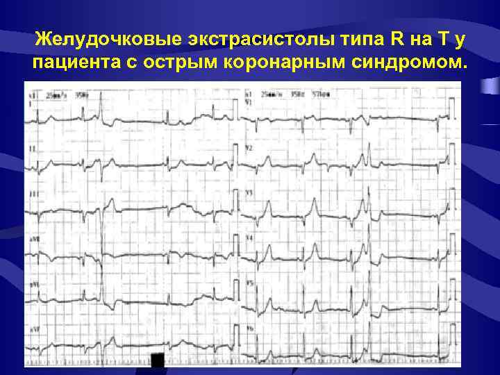 Желудочковые экстрасистолы типа R на T у пациента с острым коронарным синдромом. 