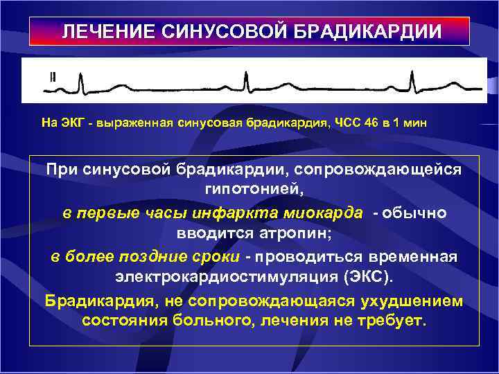  ЛЕЧЕНИЕ СИНУСОВОЙ БРАДИКАРДИИ ЛЕЧЕНИЕ На ЭКГ выраженная синусовая брадикардия, ЧСС 46 в 1