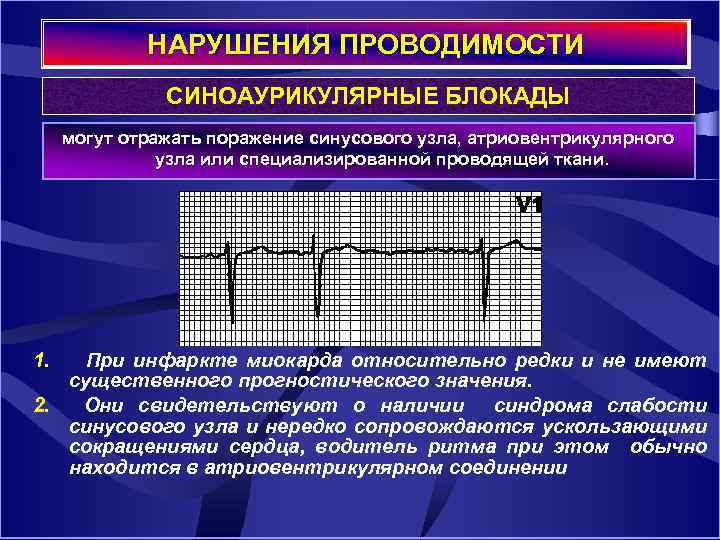 НАРУШЕНИЯ ПРОВОДИМОСТИ СИНОАУРИКУЛЯРНЫЕ БЛОКАДЫ могут отражать поражение синусового узла, атриовентрикулярного узла или специализированной проводящей