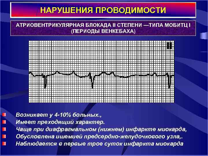 НАРУШЕНИЯ ПРОВОДИМОСТИ АТРИОВЕНТРИКУЛЯРНАЯ БЛОКАДА II СТЕПЕНИ —ТИПА МОБИТЦ I (ПЕРИОДЫ ВЕНКЕБАХА) Возникает у 4