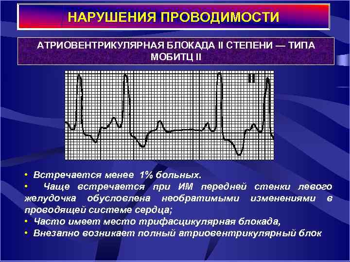 НАРУШЕНИЯ ПРОВОДИМОСТИ АТРИОВЕНТРИКУЛЯРНАЯ БЛОКАДА II СТЕПЕНИ — ТИПА МОБИТЦ II • Встречается менее 1%