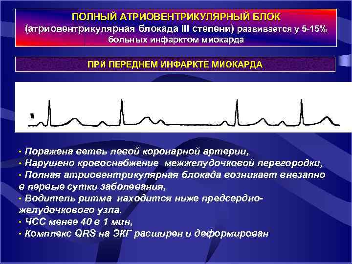 ПОЛНЫЙ АТРИОВЕНТРИКУЛЯРНЫЙ БЛОК (атриовентрикулярная блокада III степени) развивается у 5 15% больных инфарктом миокарда