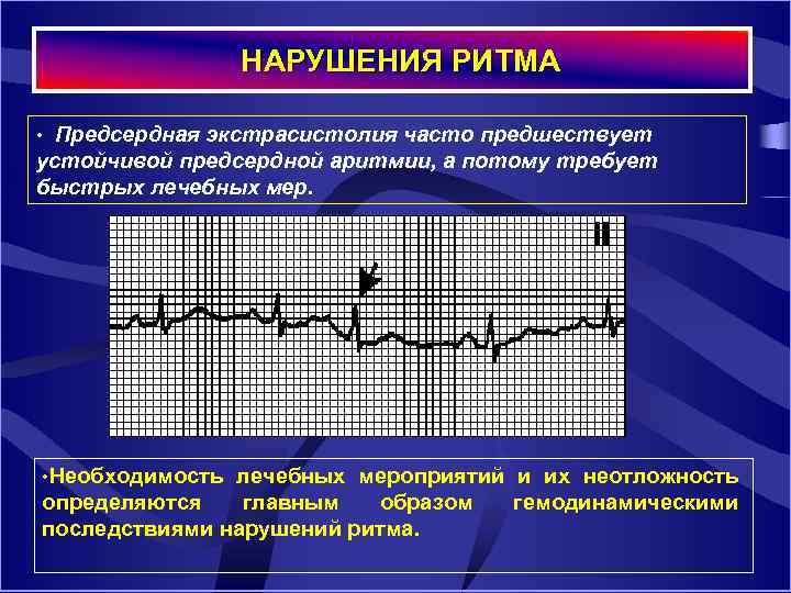  НАРУШЕНИЯ РИТМА • Предсердная экстрасистолия часто предшествует устойчивой предсердной аритмии, а потому требует