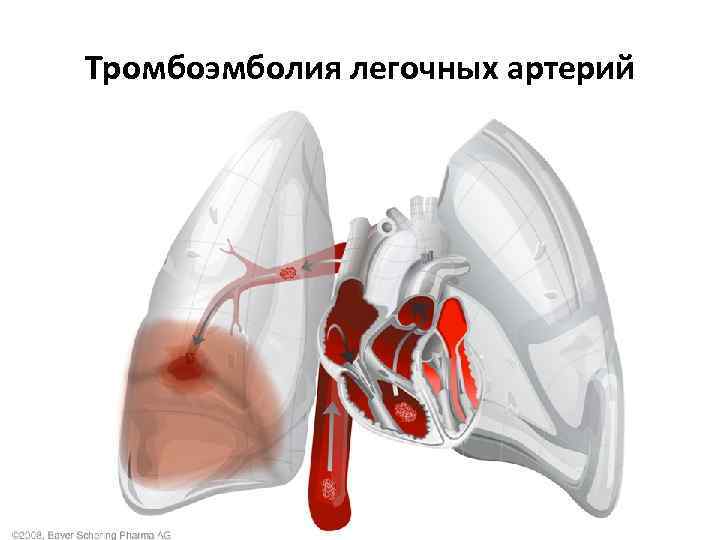Тромбоэмболия легочных артерий 