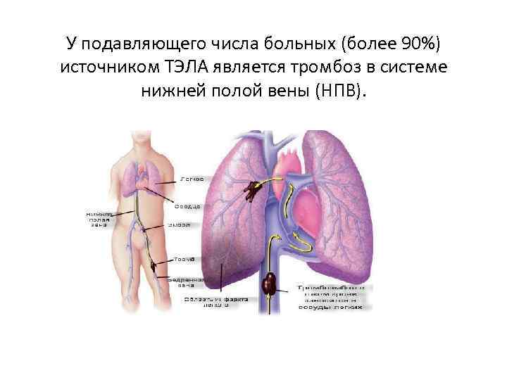 Причины возникновения тромбоза. Тромбоэмболия легочной артерии Триада Вирхова. Нижняя полая Вена тромбоз. Триада Вирхова тромбоз. Тромб нижней полой вены.