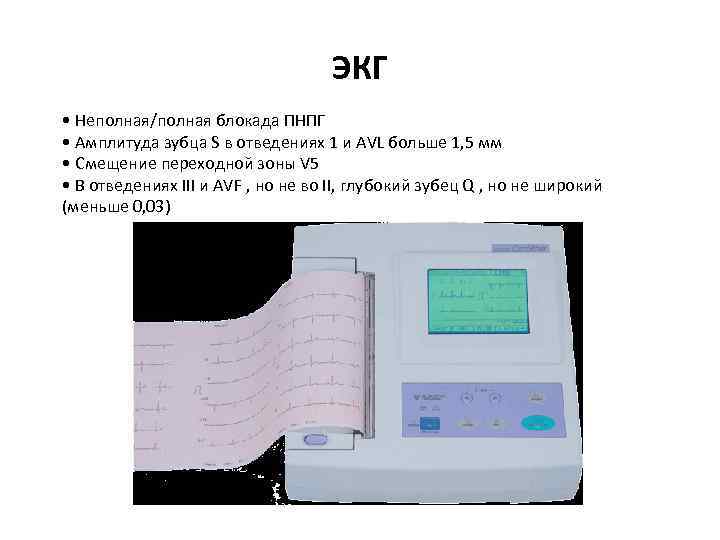 ЭКГ • Неполная/полная блокада ПНПГ • Амплитуда зубца S в отведениях 1 и АVL