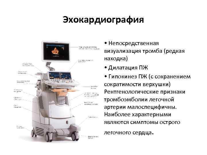 Эхокардиография • Непосредственная визуализация тромба (редкая находка) • Дилатация ПЖ • Гипокинез ПЖ (с