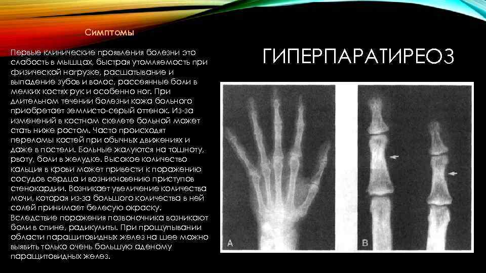 Симптомы Первые клинические проявления болезни это слабость в мышцах, быстрая утомляемость при физической нагрузке,