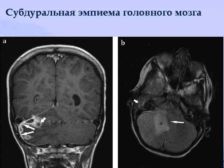 Субдуральная эмпиема головного мозга 