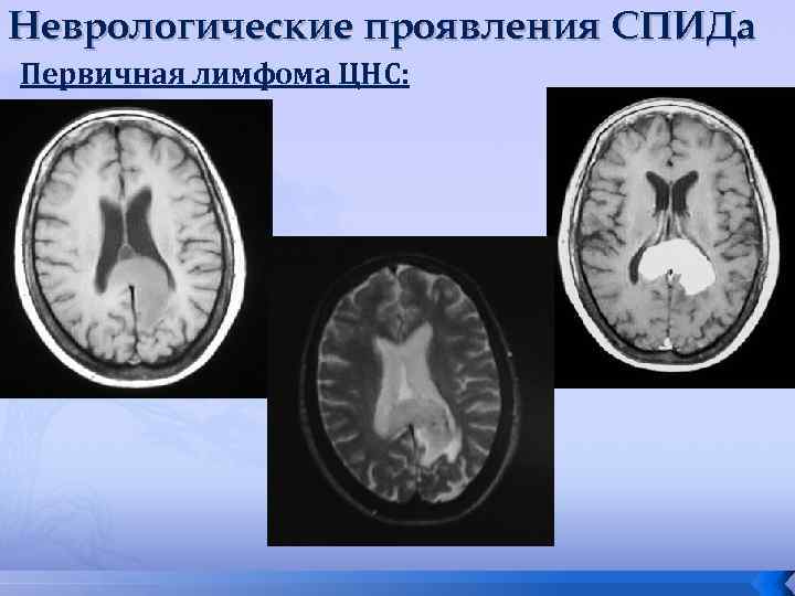 Неврологические проявления СПИДа Первичная лимфома ЦНС: 