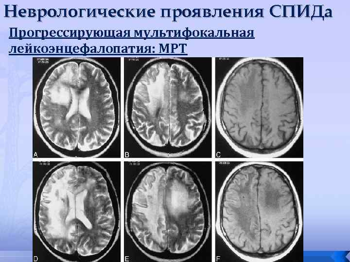 Неврологические проявления СПИДа Прогрессирующая мультифокальная лейкоэнцефалопатия: МРТ 