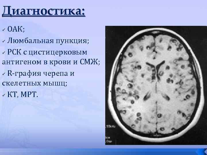 Нейроспид. Паразитарные заболевания ЦНС. Поражение ЦНС при СПИДЕ. Паразитарные заболевания головного мозга. Нейроспид диагностика.