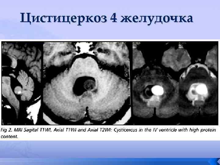 Цистицеркоз 4 желудочка 