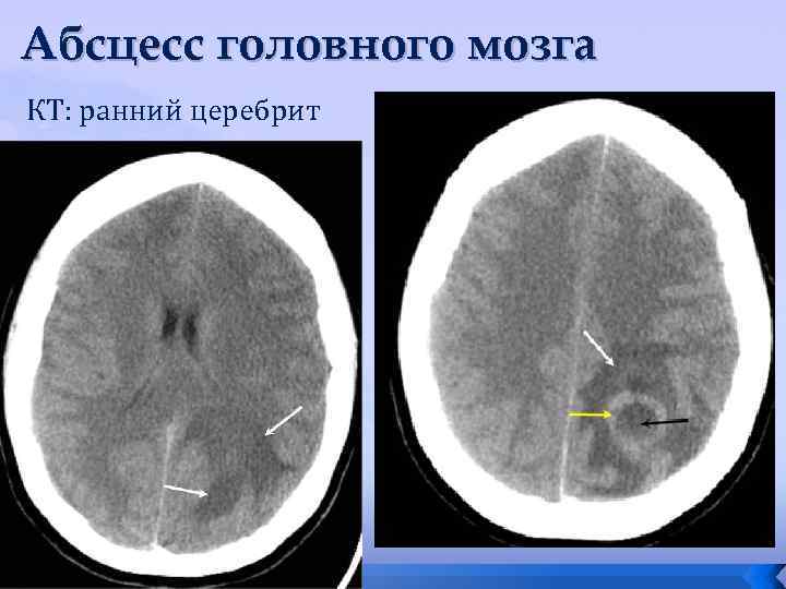 Абсцесс головного мозга КТ: ранний церебрит 