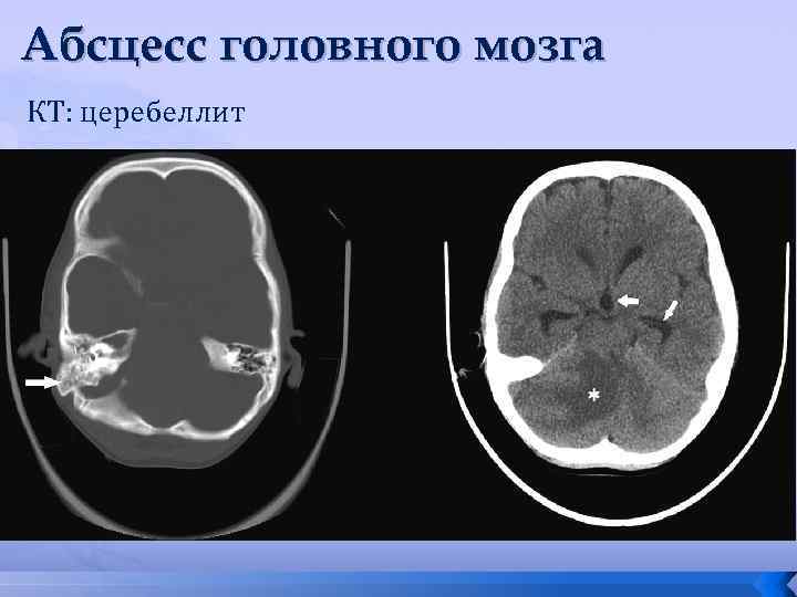 Абсцесс головного мозга КТ: церебеллит 