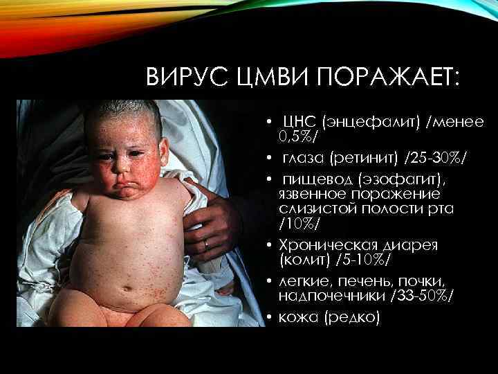 ВИРУС ЦМВИ ПОРАЖАЕТ: • ЦНС (энцефалит) /менее 0, 5%/ • глаза (ретинит) /25 -30%/