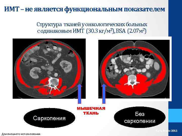 ИМТ – не является функциональным показателем Структура тканей у онкологических больных с одинаковым ИМТ