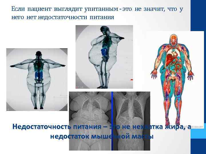 Если пациент выглядит упитанным - это не значит, что у него нет недостаточности питания