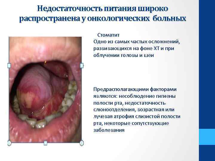 Недостаточность питания широко распространена у онкологических больных Стоматит Одно из самых частых осложнений, развивающихся