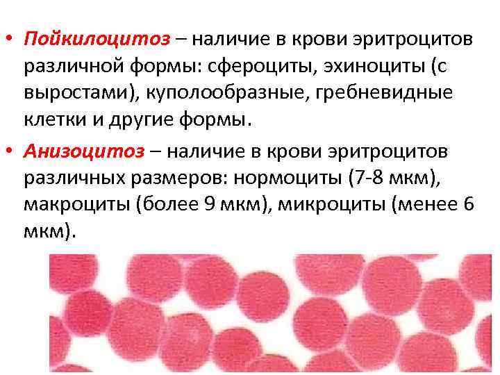  • Пойкилоцитоз – наличие в крови эритроцитов различной формы: сфероциты, эхиноциты (с выростами),