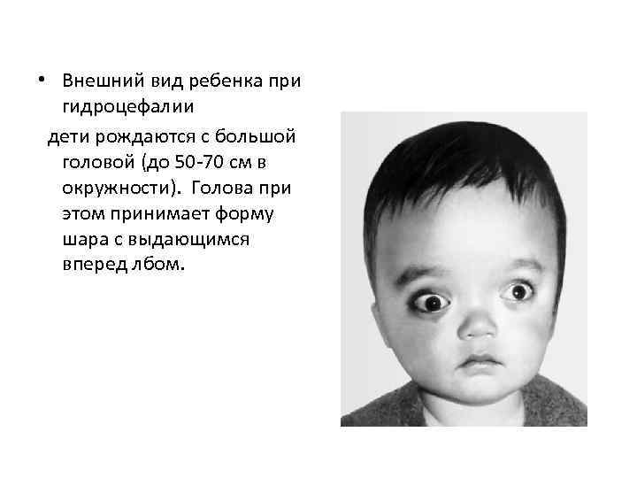  • Внешний вид ребенка при гидроцефалии дети рождаются с большой головой (до 50