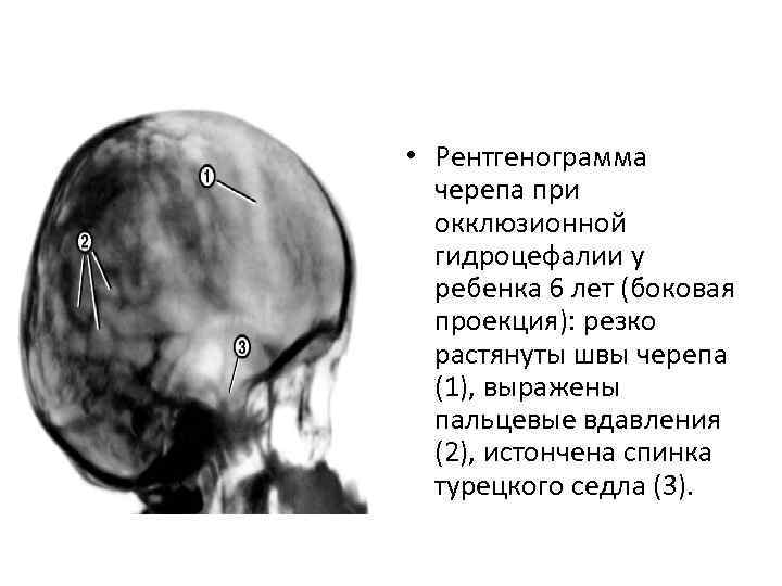  • Рентгенограмма черепа при окклюзионной гидроцефалии у ребенка 6 лет (боковая проекция): резко