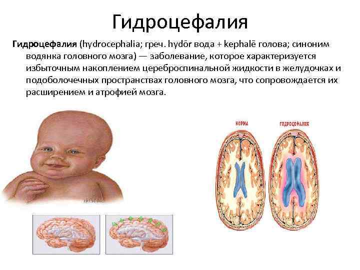 Гидроцефалия (hydrocephalia; греч. hydōr вода + kephalē голова; синоним водянка головного мозга) — заболевание,