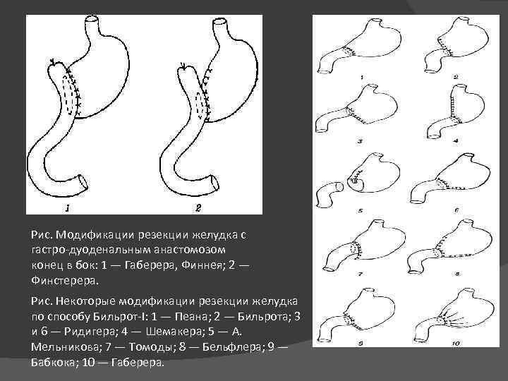 Рис. Модификации резекции желудка с гастро-дуоденальным анастомозом конец в бок: 1 — Габерера, Финнея;