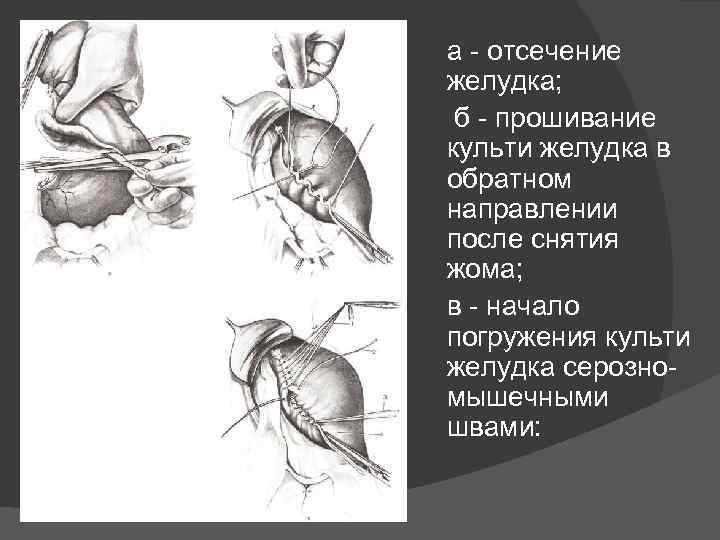 а - отсечение желудка; б - прошивание культи желудка в обратном направлении после снятия