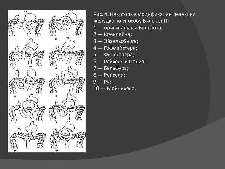 Рис. 4. Некоторые модификации резекции желудка по способу Бильрот-II: 1 — оригинальная Бильрота; 2