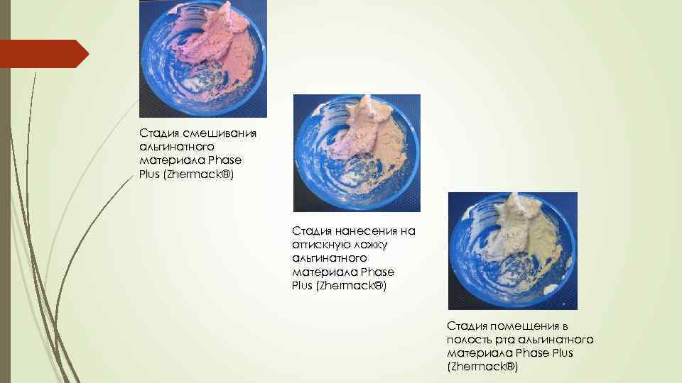 Стадия смешивания альгинатного материала Phase Plus (Zhermack®) Стадия нанесения на оттискную ложку альгинатного материала