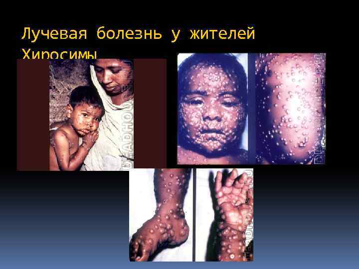 Лучевая болезнь у жителей Хиросимы 