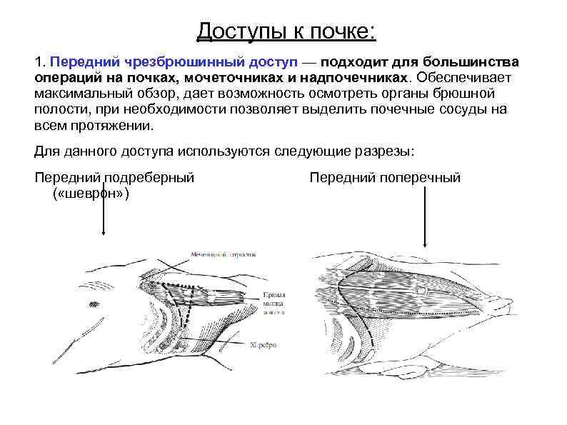 Доступы к почке: 1. Передний чрезбрюшинный доступ — подходит для большинства операций на почках,