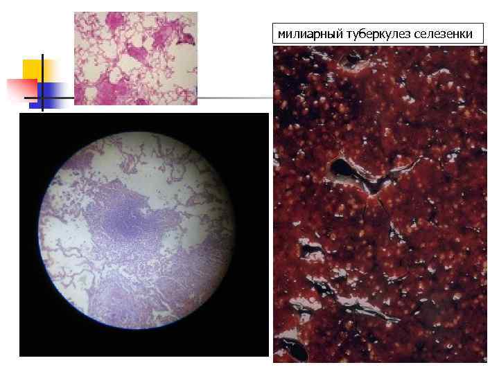 милиарный туберкулез селезенки 