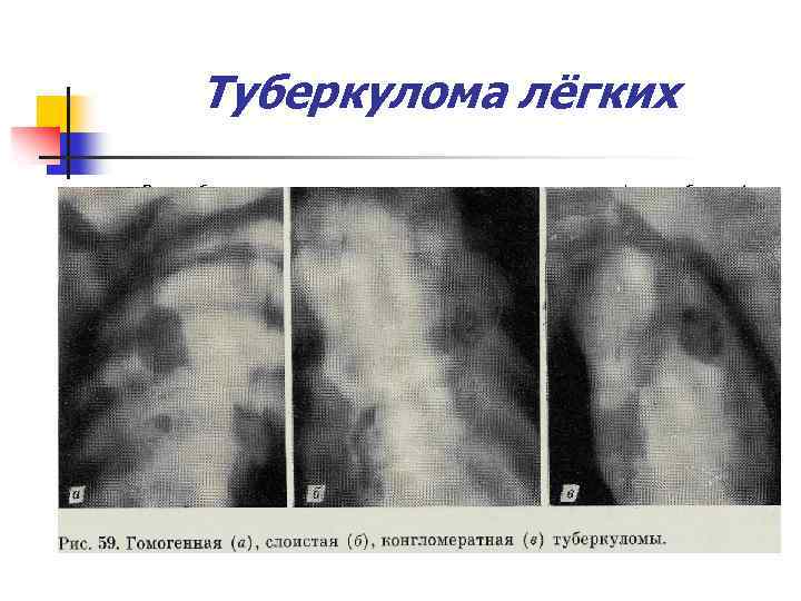 Туберкулома лёгких Разнообразные по генезу инкапсулированные казеозные фокусы более 1 см вследствие исхода других