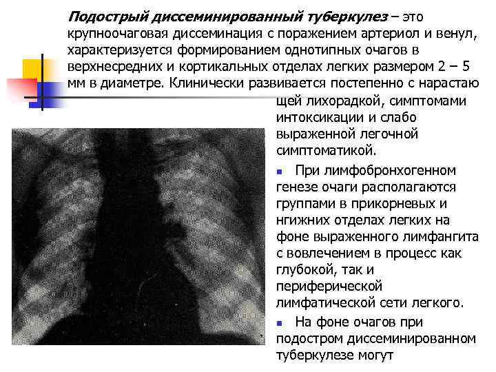 Подострый диссеминированный туберкулез – это крупноочаговая диссеминация с поражением артериол и венул, характеризуется формированием