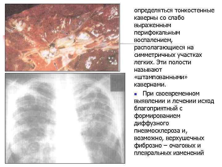 определяться тонкостенные каверны со слабо выраженным перифокальным воспалением, располагающиеся на симметричных участках легких. Эти