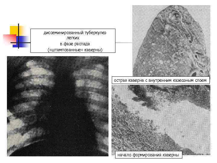 диссеминированный туберкулез легких в фазе распада ( «штампованные» каверны) острая каверна с внутренним казеозным